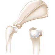 Osteochondritis&nbsp;dissecans